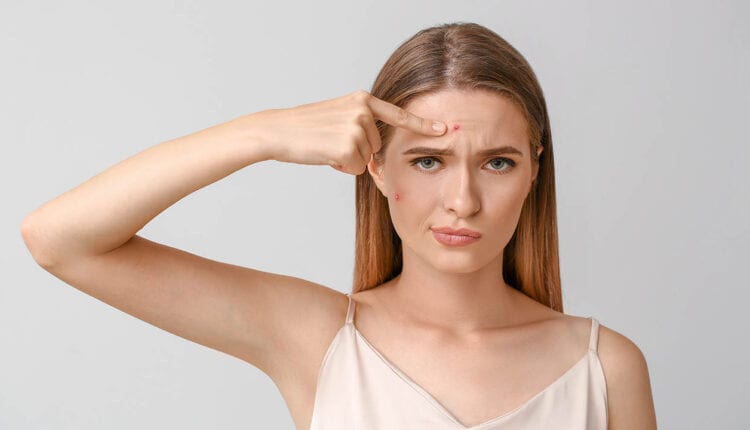 טיפול באקנה